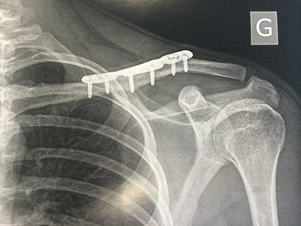 Réduction, Stabilisation de Fracture de clavicule Chirurgie