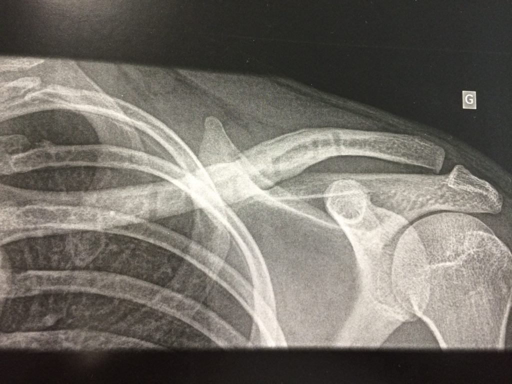 Réduction, Stabilisation de Fracture de clavicule Chirurgie