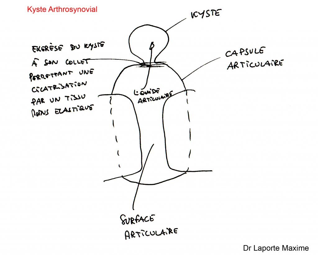 Kyste-arthrosynovial-Chirurgie-Orthopédique-Langon