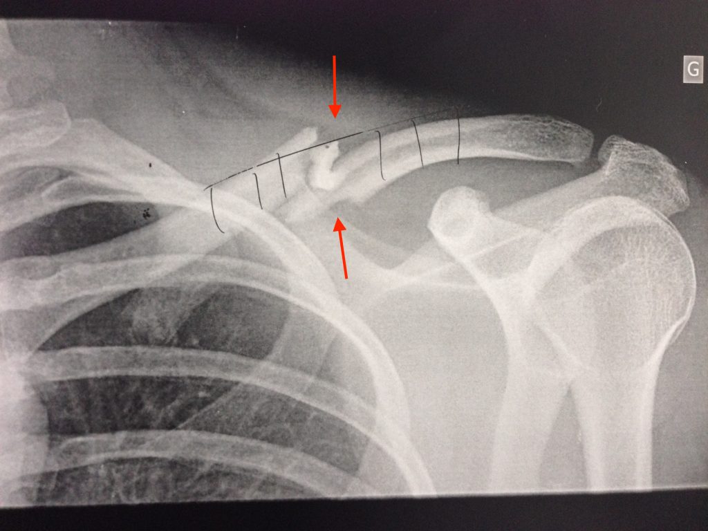 Réduction, Stabilisation de Fracture de clavicule Arthropole Sud Gironde Bordeaux Langon