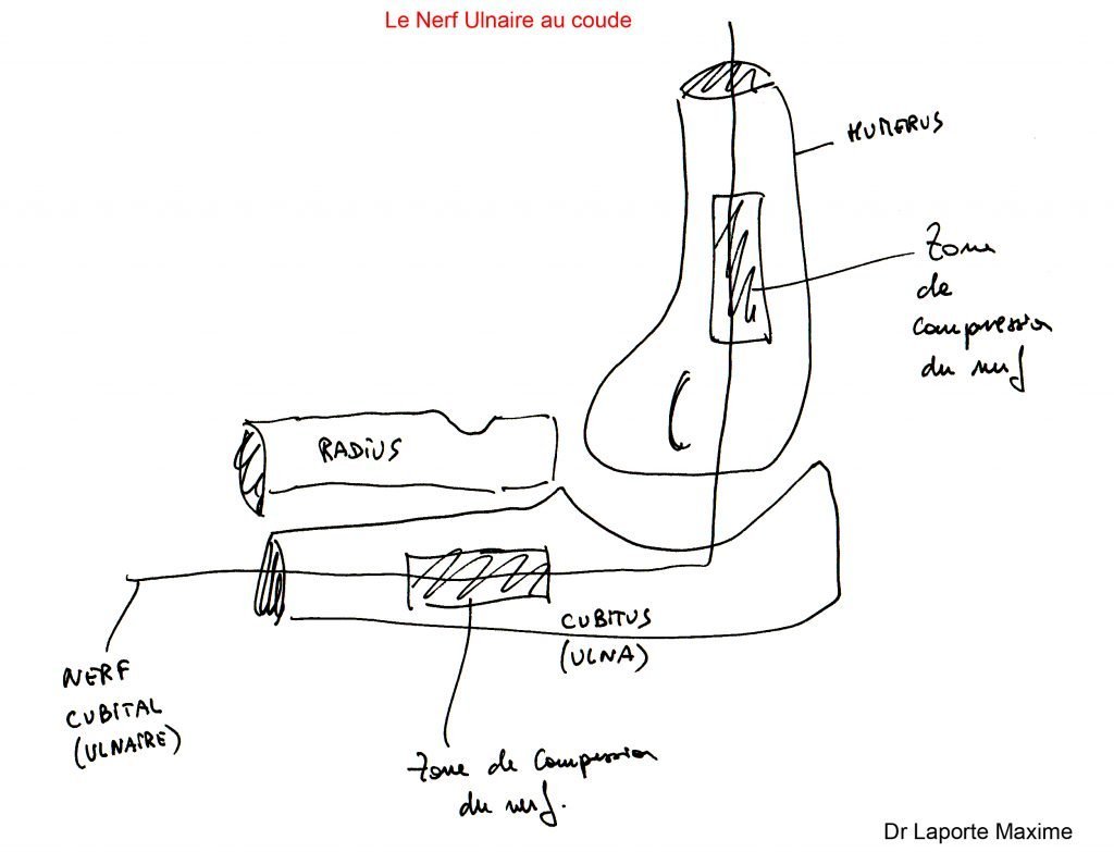 Neurolyse du nerf ulnaire (compression du nerf cubital au coude ...