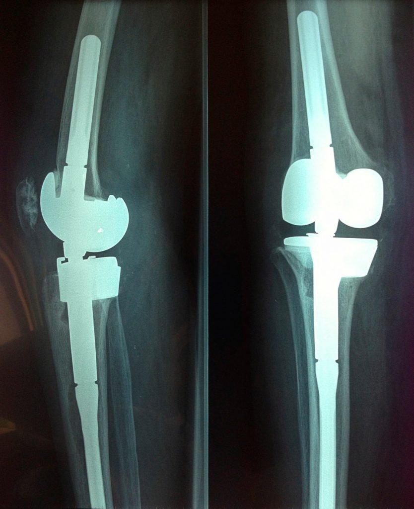 Prothèse totale de genou | Chirurgie Orthopédique et Traumatologie