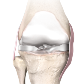 genou-arthrose-remplacement-robot