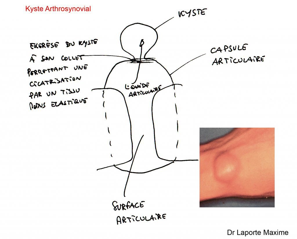 Attelle poignet kyste synovial