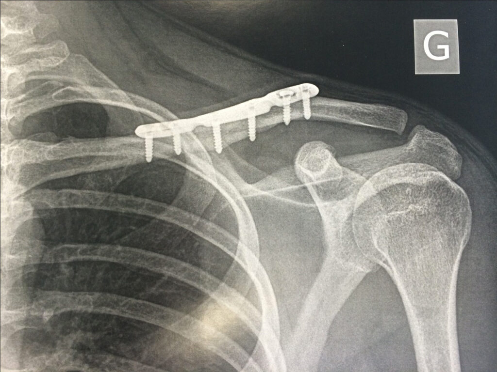 Réduction, Stabilisation de Fracture de clavicule | Arthropole Sud ...