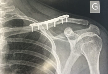 fracture-clavicule-chirurgie-2-arthropole-sud-gironde